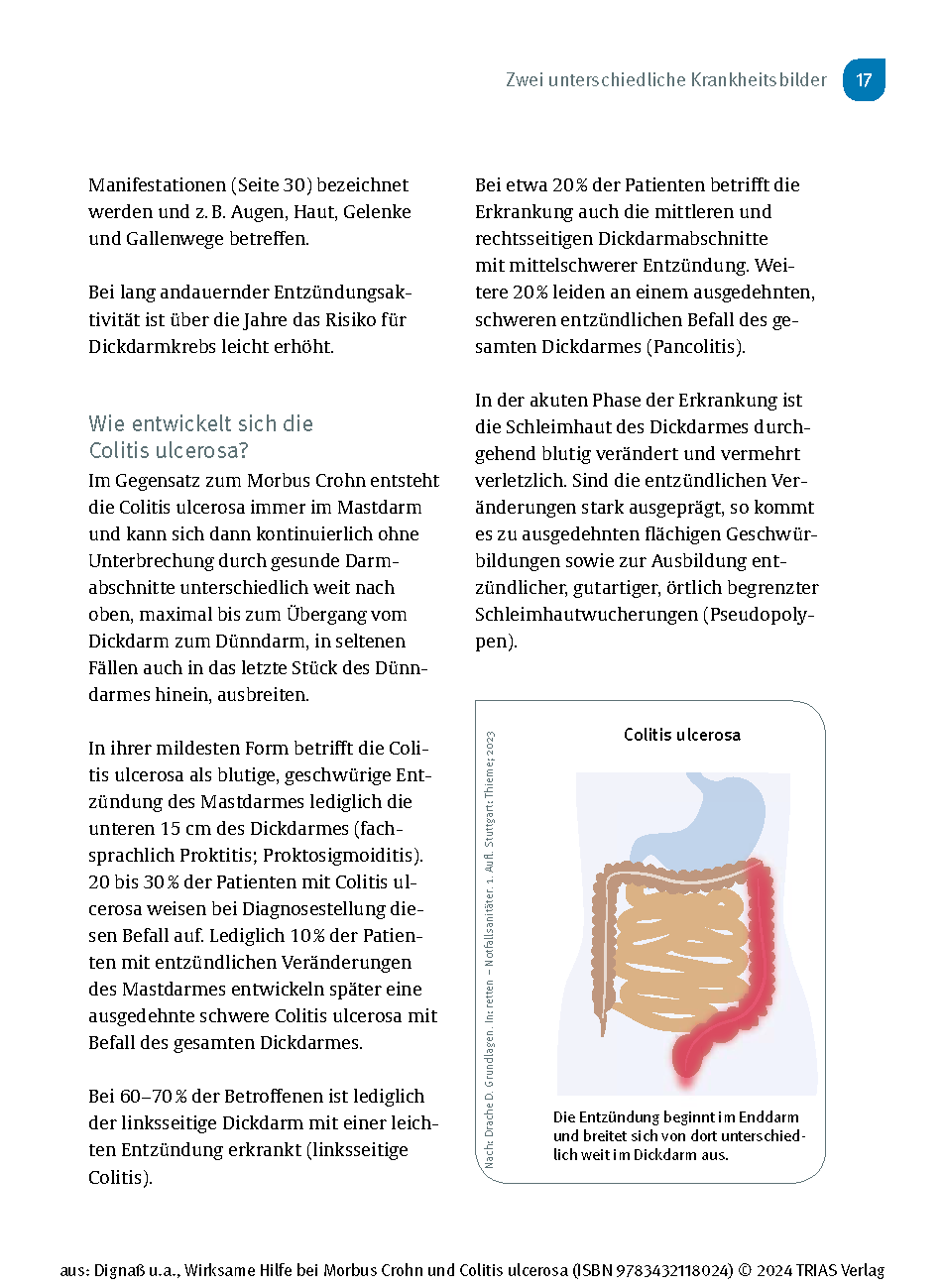 Wirksame Hilfe bei Morbus Crohn und Colitis ulcerosa